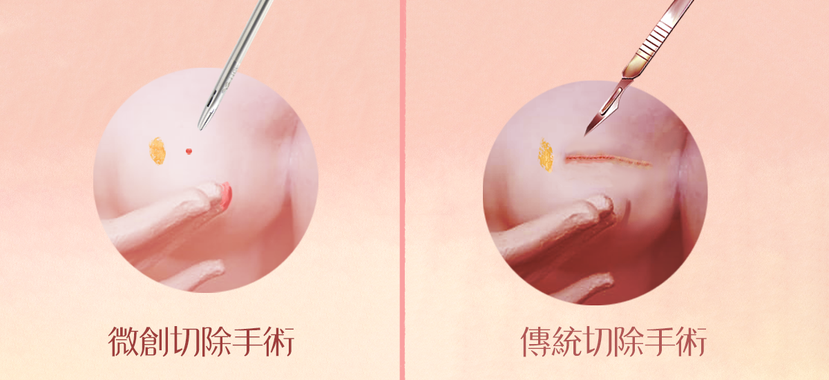 【衛教馨知】乳房纖維囊腫變化要不要切除？